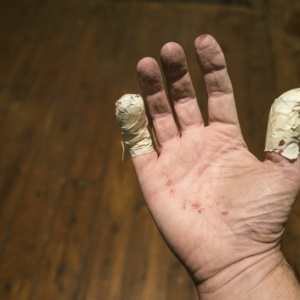 Hand Injuries